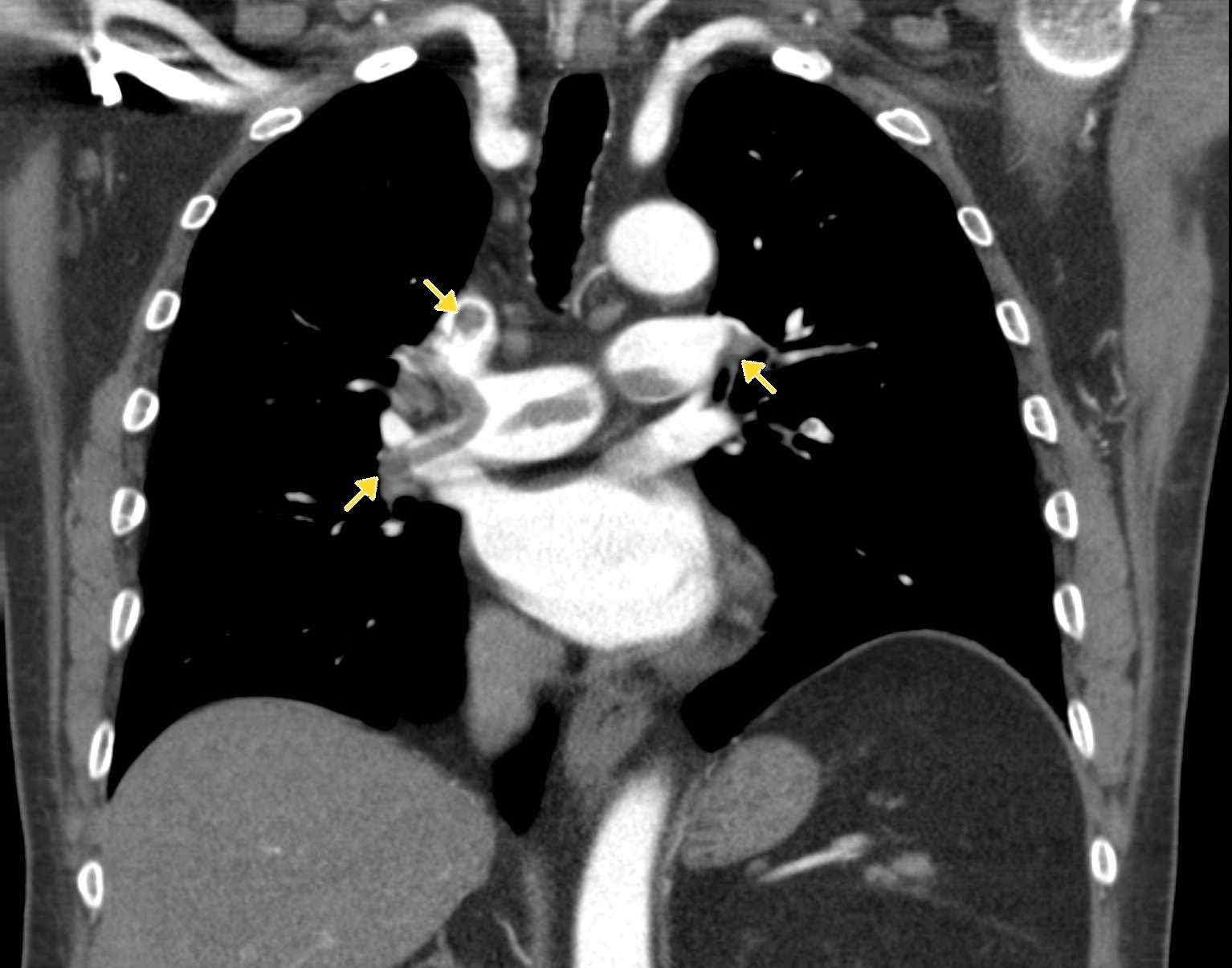 M4 Image 3 Pulmonary Embolus