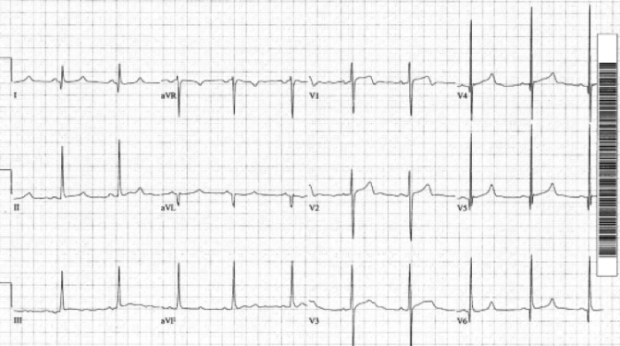 Peds Fig 4 Rhythm Interp -hypertrophic_cardiomyopathy
