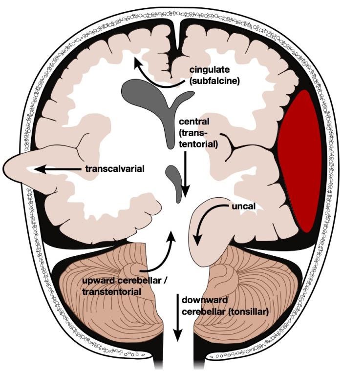 M4 Fig 7 Closed Head Injury