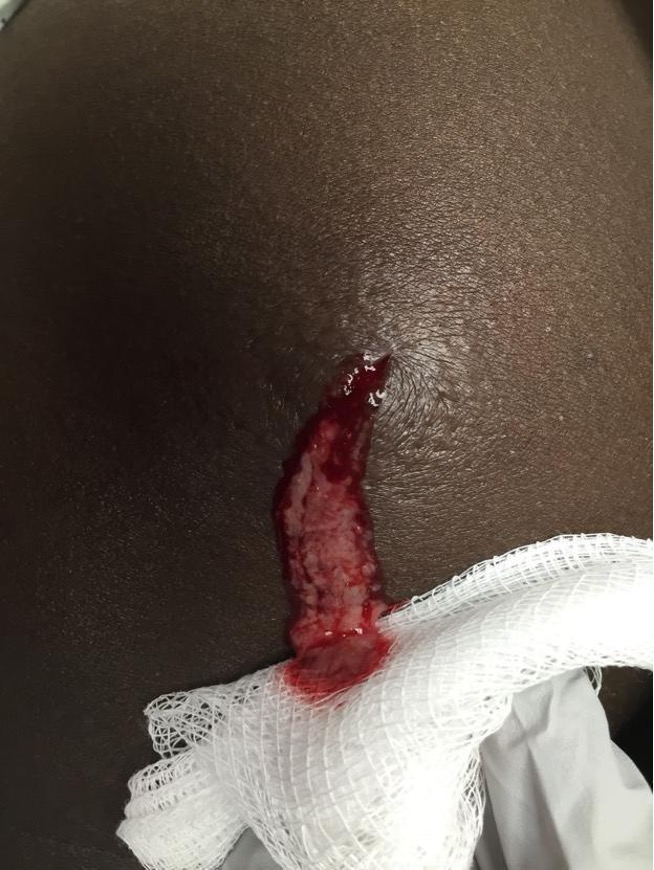 Abscess incision and drainage