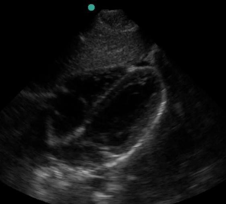 Figure, B-Mode ultrasound showing main portal] - StatPearls