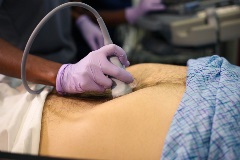 aortatransverseproximal2