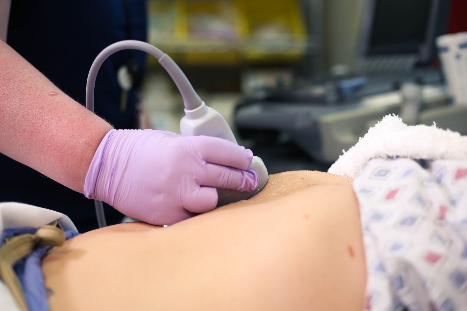 biliarysubcostal3