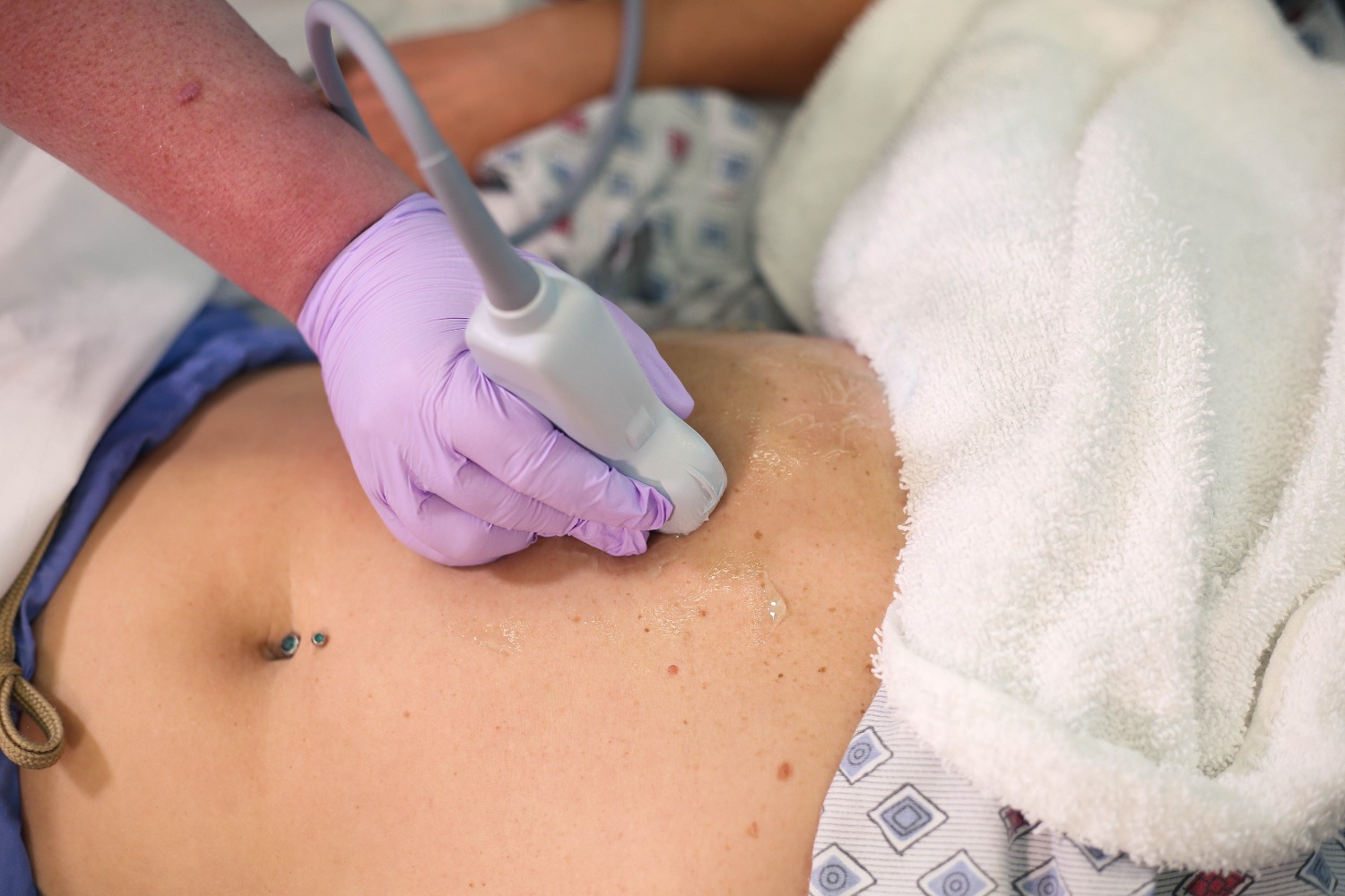 biliarysubcostal6