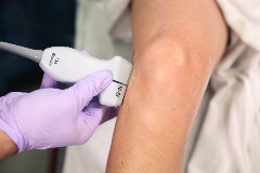 lateralmeniscus_LCL1