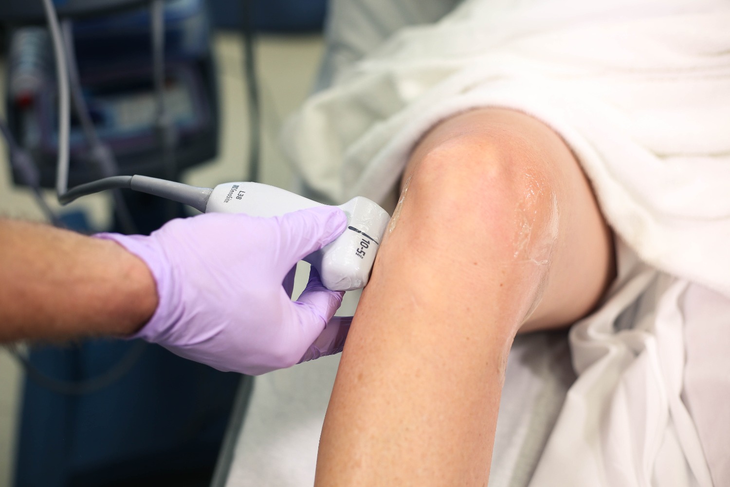 lateralmeniscus_LCL2