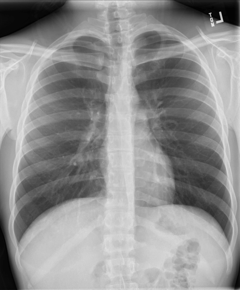Chest Radiograph