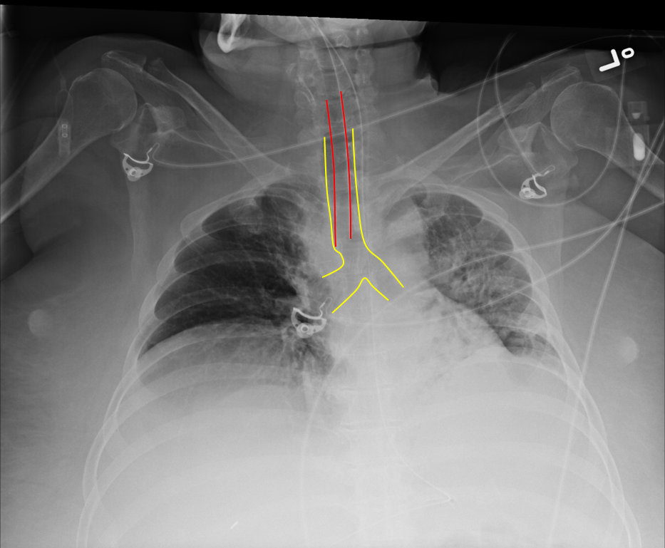 Endotracheal Tube Placement X Ray