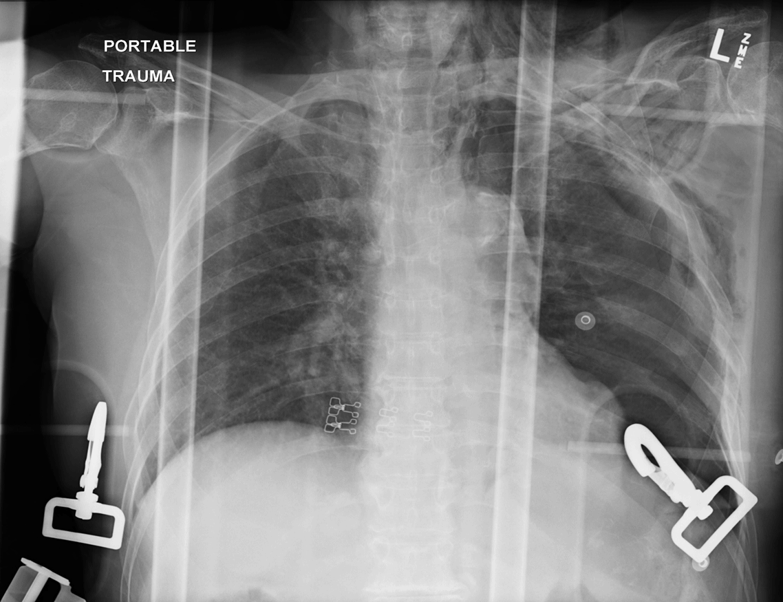 Chest Radiograph