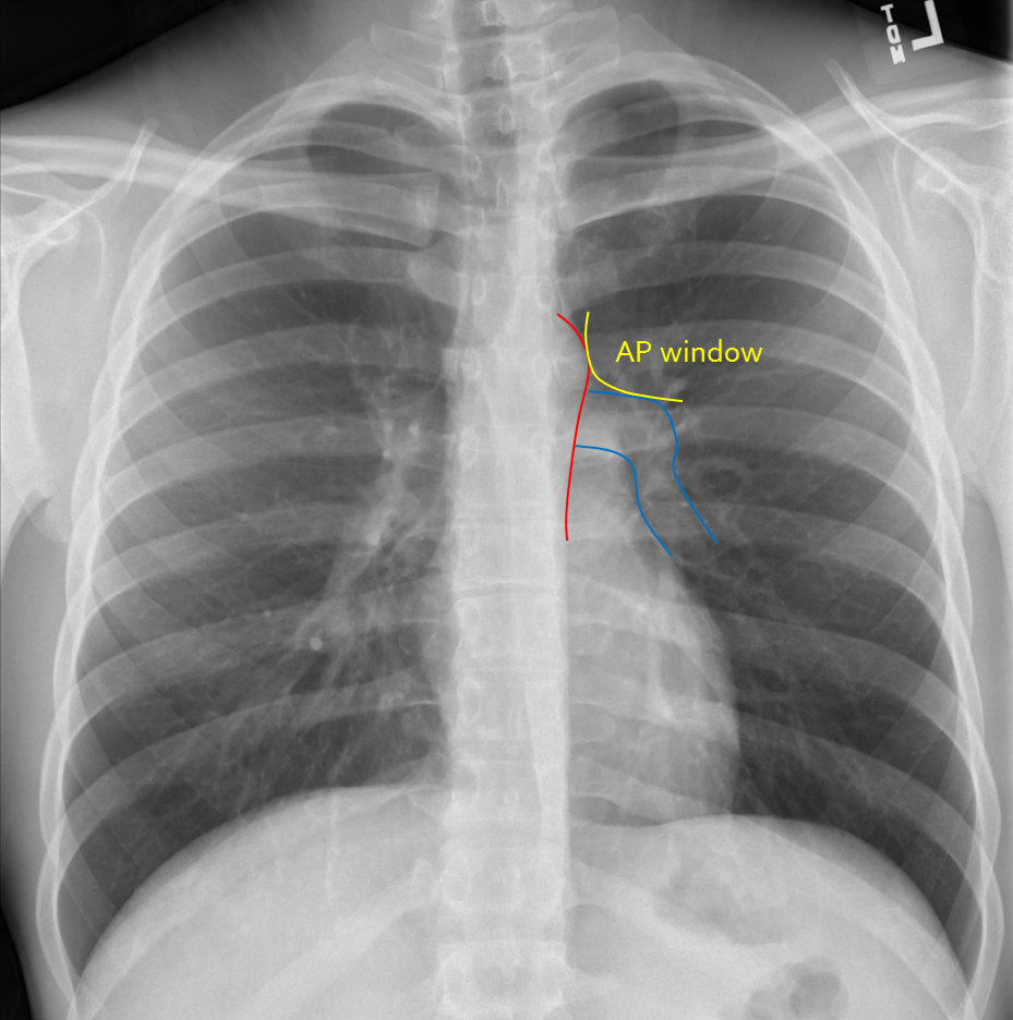 Chest Radiograph