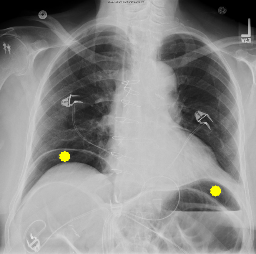 Chest X Ray Showing Air Under The Diaphragm Download vrogue.co