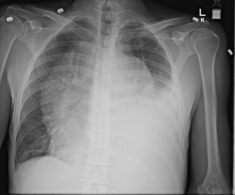 Chest Radiograph