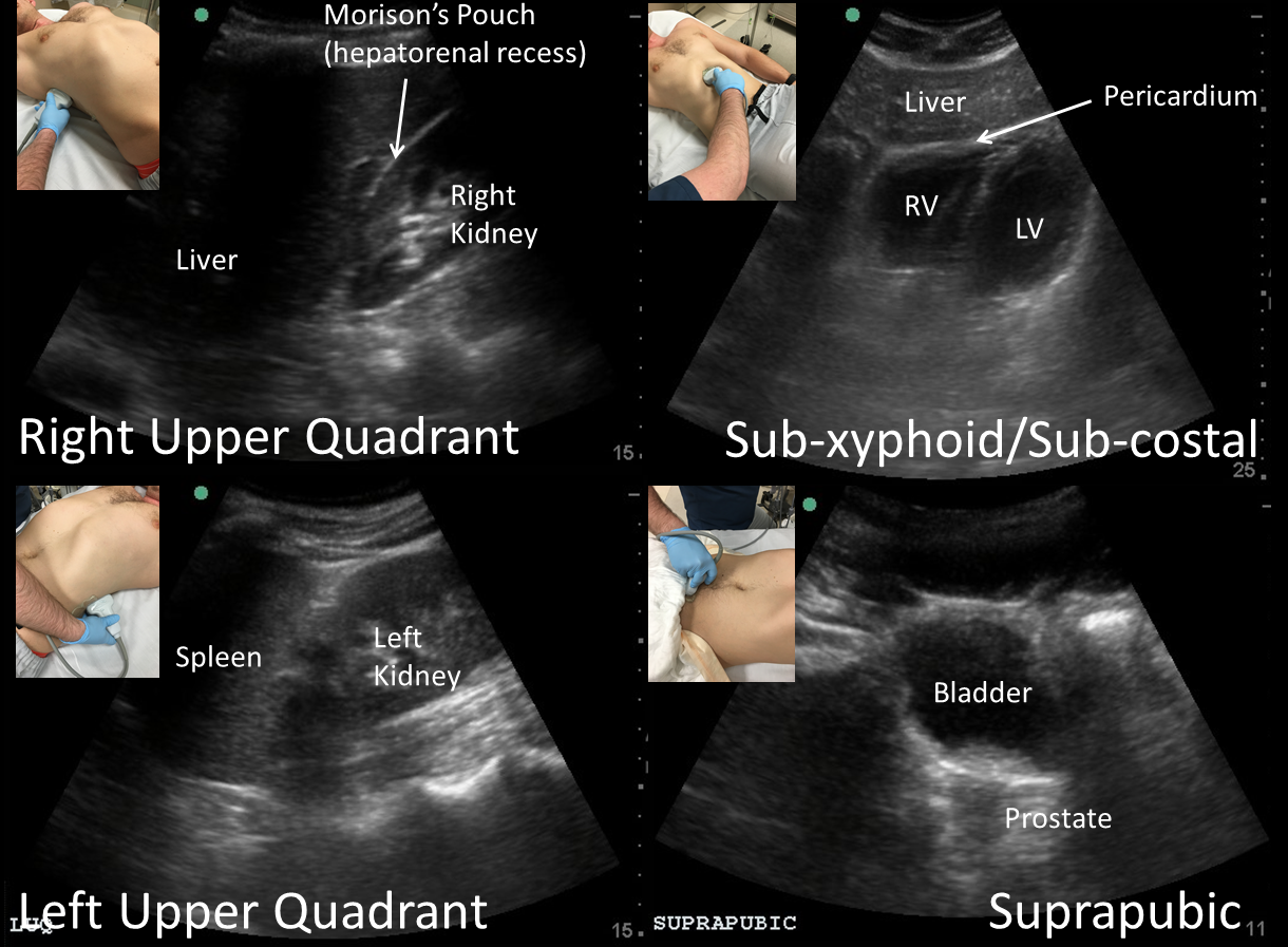 M3 Fig 10 Bedside Ultrasound-normal-fast