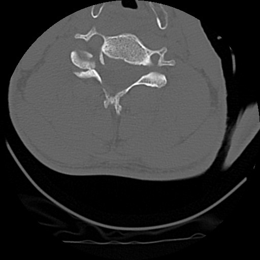 M3 Fig 11 Cervical Spine-unilateral-facet-dislocation