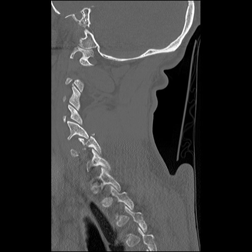 M3 Fig 12 Cervical Spine-unilateral-facet-dislocation-ct