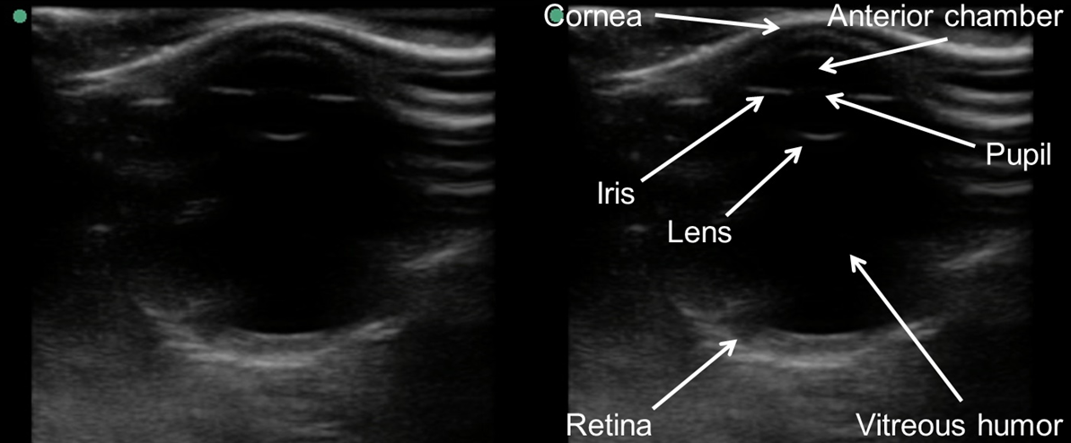 M3 Fig 13 Bedside Ultrasound-ocular