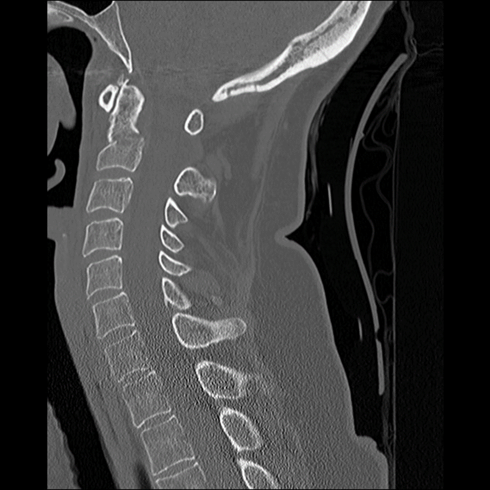 M3 Fig 14 Cervical Spine-type-3-odontoid-ct