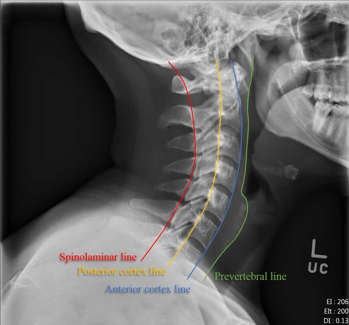 dislocated neck x ray