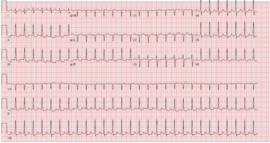 M3 Fig 3 Circulation -paroxysmal-supraventricular-tachycardia
