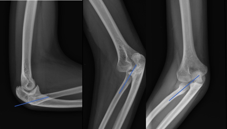 M3 Fig 3 Orthopedic Injuries -radiocapitellar-line1