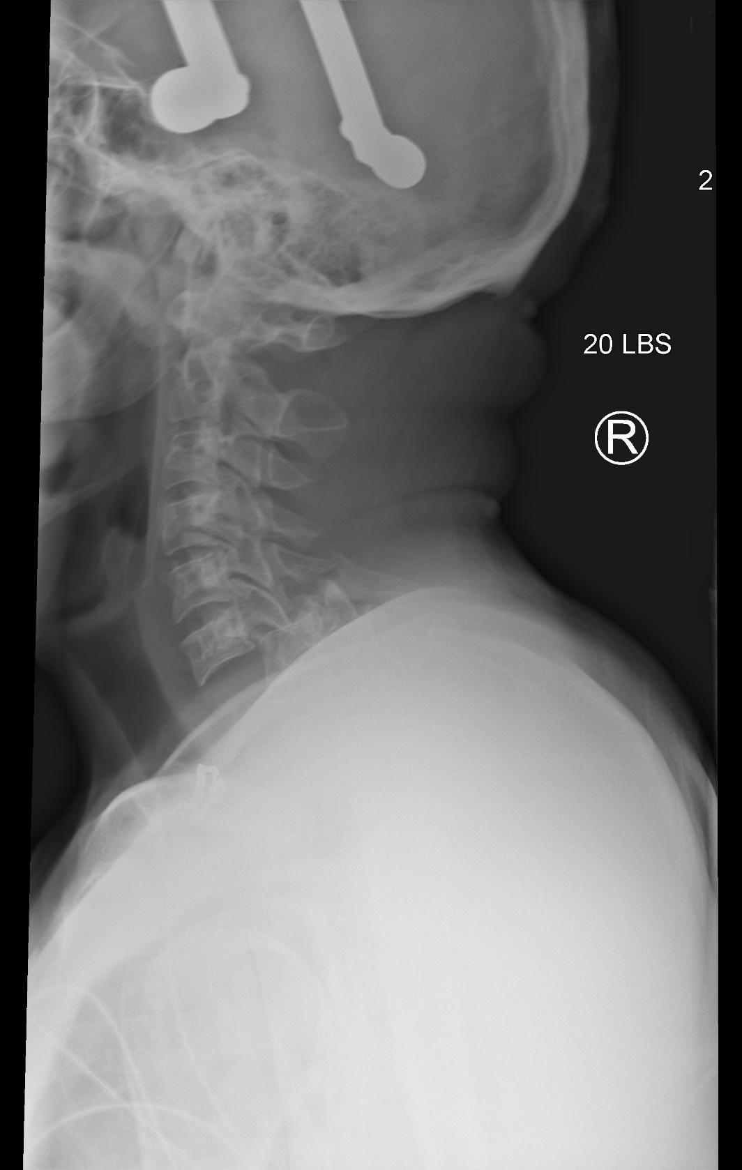 M3 Fig 4 Cervical Spine-bilateral-facet-dislocation
