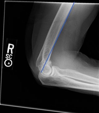 M3 Fig 4 Orthopedic Injuries -anterior-humeral-line