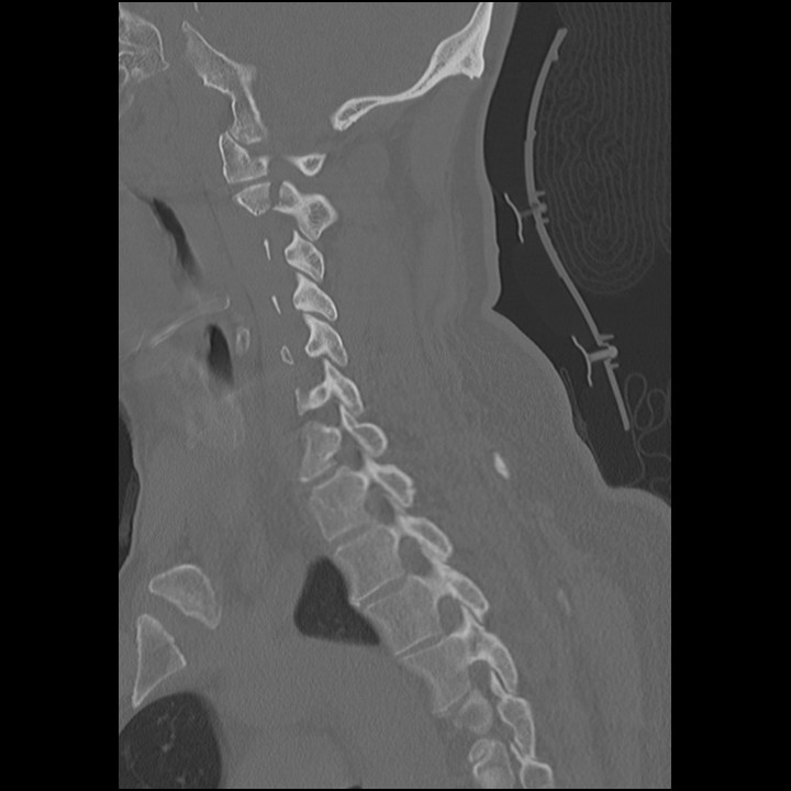 M3 Fig 7 Cervical Spine-hangmans-ct