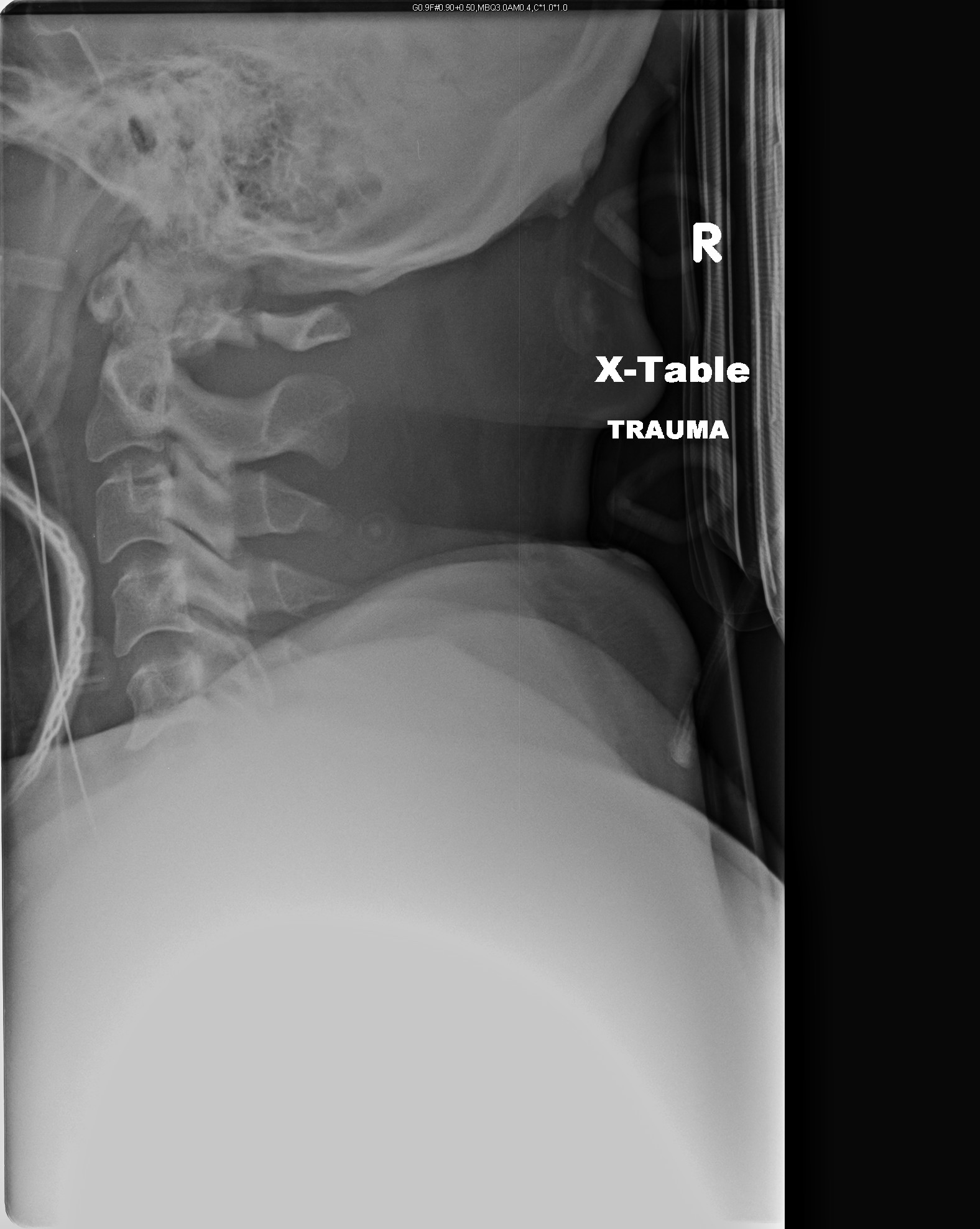 Cervical Spine Imaging in Trauma