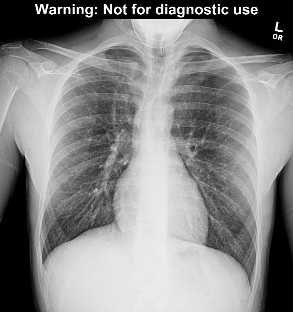 Figure 1a – chest x-ray with pneumothorax