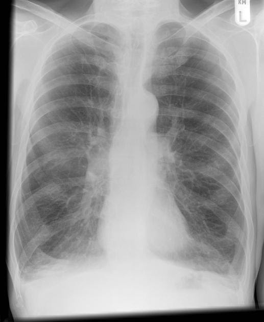 M4 Fig 1 COPD: Radiographic Studies