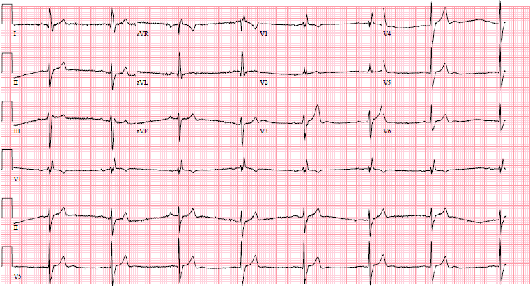 M4 Fig 1 Hyperkalemia