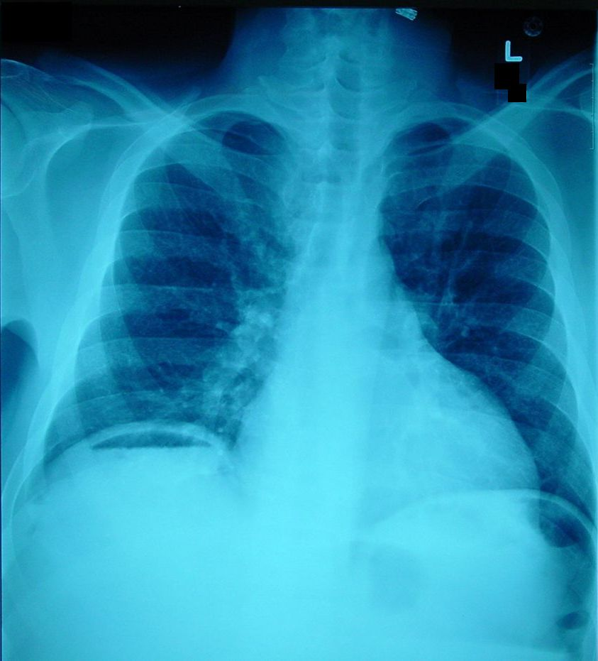 M4 Fig 1 Perforated Viscus