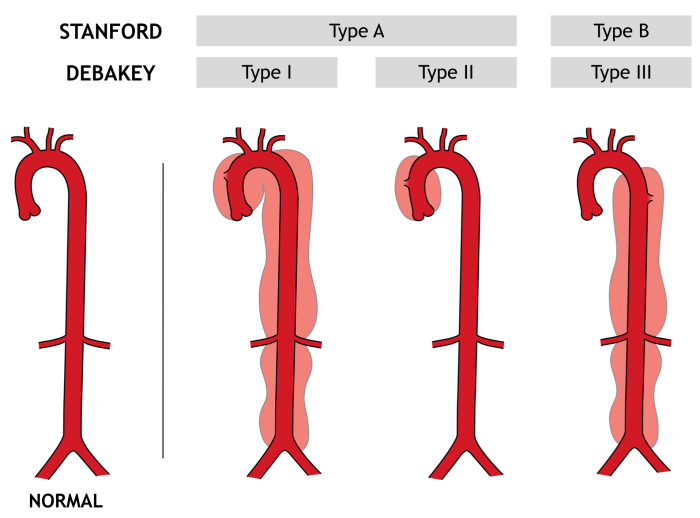 M4 Fig 1 Thoracic Aortic Dissection Aortic dissection classification