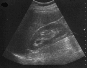 M4 Fig 2 Abdominal - Normal FAST exam window showing the liver and the spleen