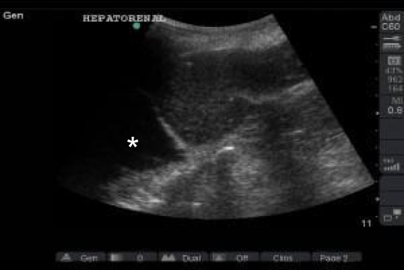 M4 Fig 2 Chest Trauma - Hepatorenal view ultrasound
