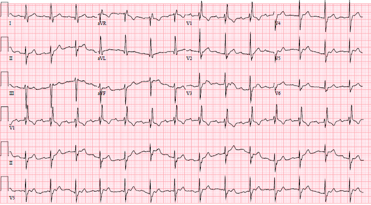 M4 Fig 2 Hyperkalemia