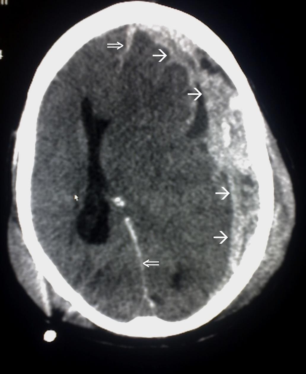 M4 Fig 2 Intracranial Hemorrhage CT