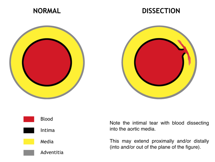 M4 Fig 2 Thoracic Aortic Dissection Cross section through the aorta
