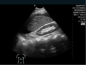M4 Fig 3 Abdominal - Positive FAST image of LUQ