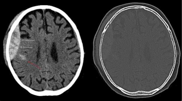 M4 Fig 3 Intracranial Hemorrhage CT