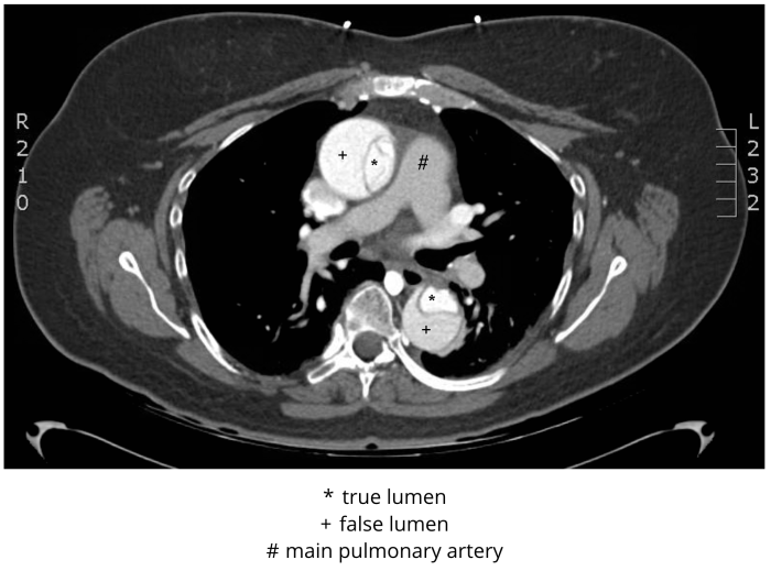 M4 Fig 3 Thoracic Aortic Dissection CT Stanford type A -DeBakey type I- dissection
