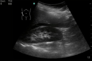 M4 Fig 4 Abdominal -Positive FAST image of RUQ 