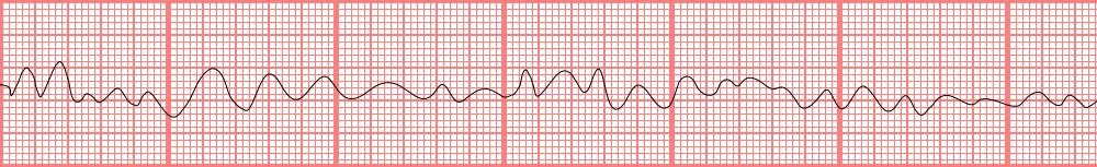 M4 Fig 4 Cardiac Arrest
