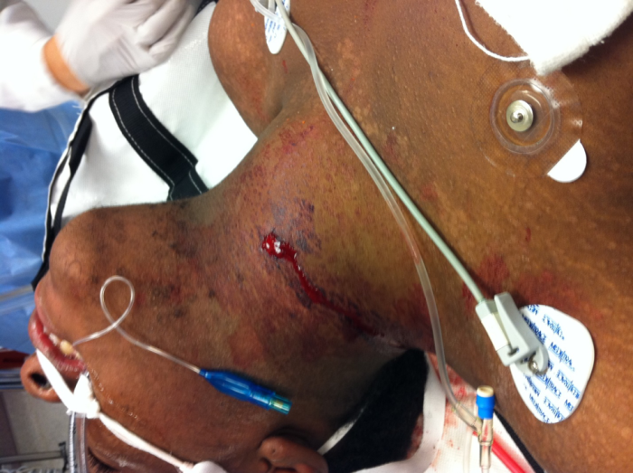 M4 Fig 4 Neck Trauma - Gunshot wound to the neck with hematoma causing airway compromise