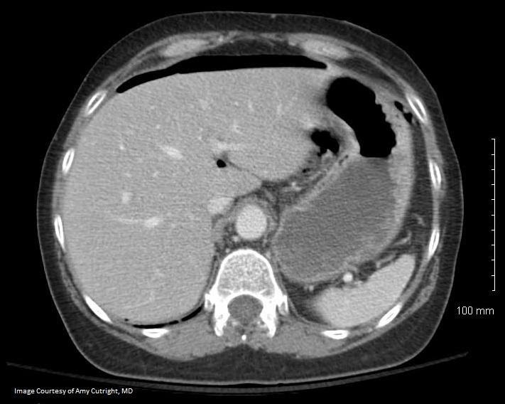 M4 Fig 4 Perforated Viscus