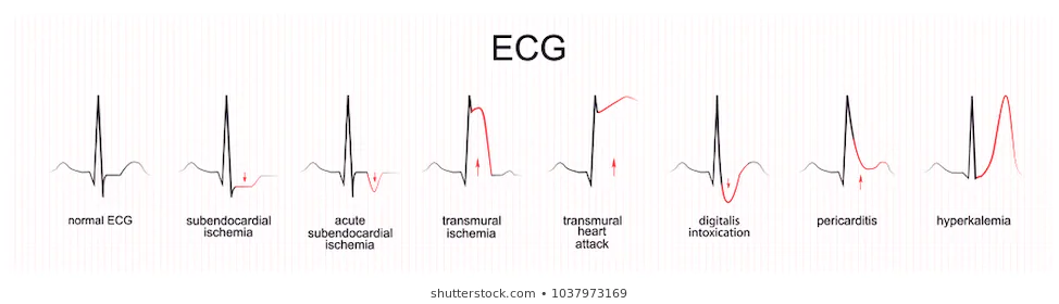 M4 Fig 5 Acute Coronary Syndromes ECG