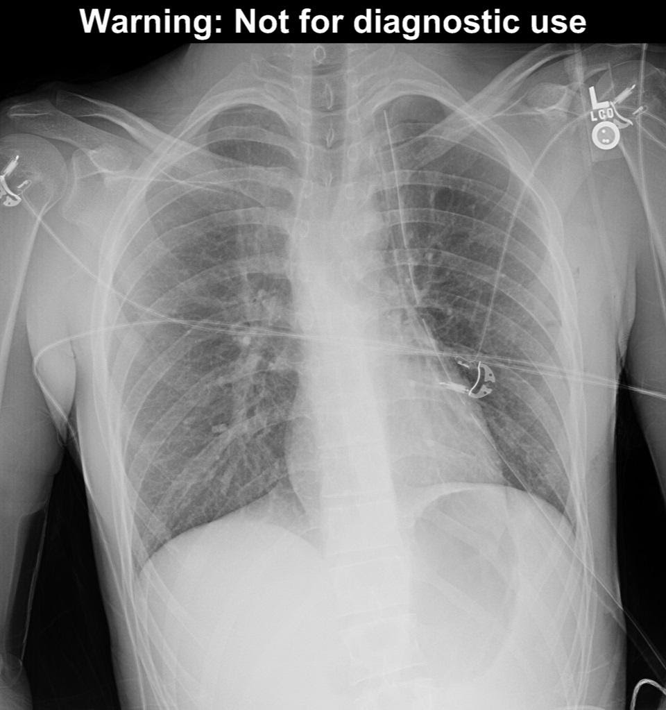 M4 Fig 8 Pneumothorax – The patient from figure 7, with a chest tube in place