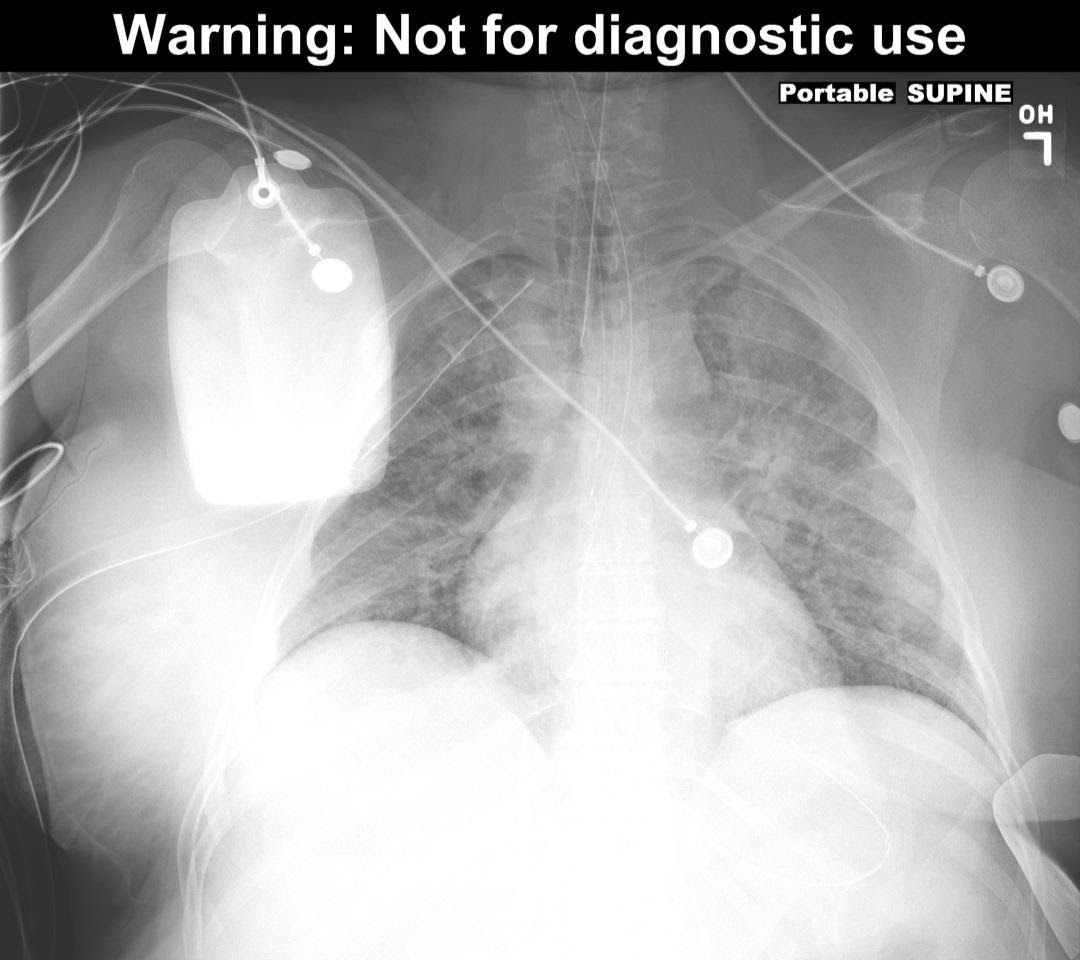 M4 Fig 9 Pneumothorax– Resolution of deep sulcus sign after chest tube placement