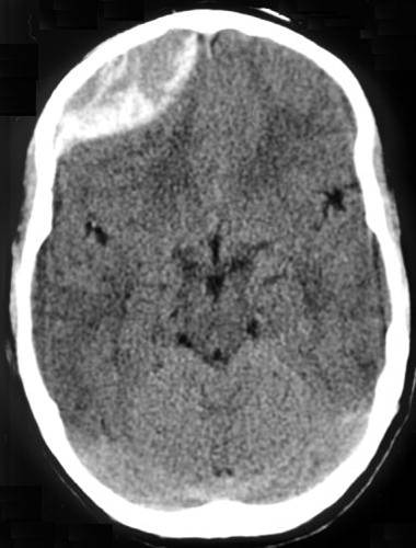 Peds Fig 1 Head Injury -traumatic_acute_epidual_hematoma