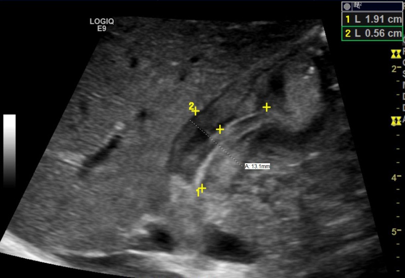 Peds Fig 1 pyloric-stenosis